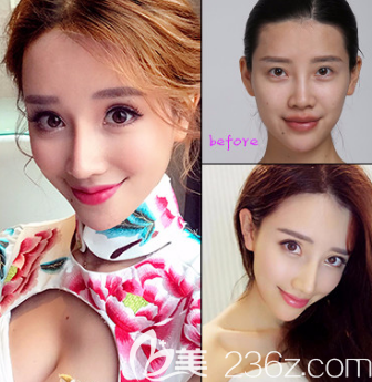 煙臺鵬愛雙眼皮案例