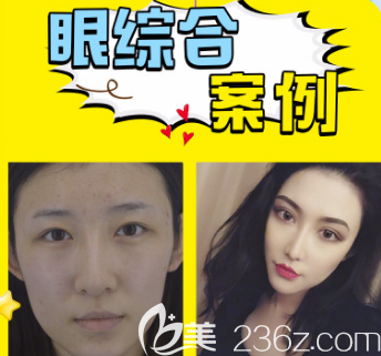 煙臺王玉珍雙眼皮案例