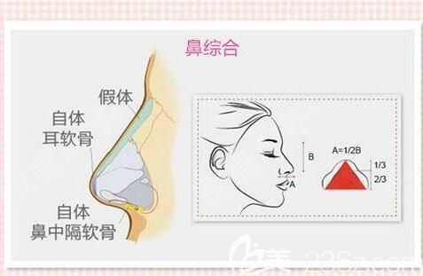 哪種隆鼻效果自然挺立