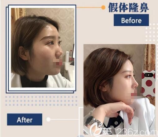 洛陽華美假體鼻綜合前后對比照片