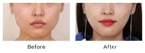 沈陽百嘉麗注射瘦臉瘦臉真人前后效果對比照