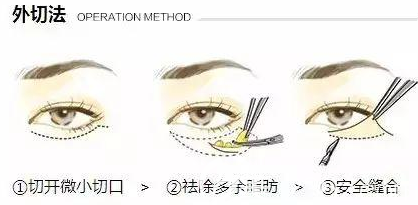 外切法祛眼袋手術示意圖