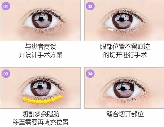 眼底脂肪重制(祛眼袋)方法 眼底脂肪重制(祛眼袋)方法