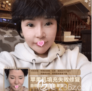 北京藝美王東醫(yī)生面部脂肪填充失敗修復(fù)