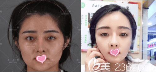 北京上上相鄭楚蓉面部脂肪填充失敗修復(fù)