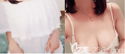 馮斌醫(yī)生胸部脂肪填充失敗修復(fù)