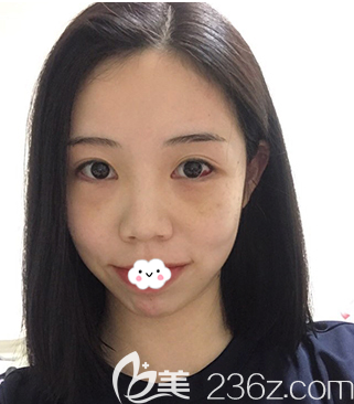 眼底脂肪重排術(shù)后第5天恢復效果圖