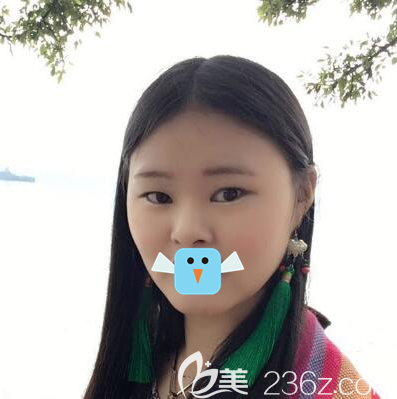 面部吸脂+雙眼皮+隆鼻術(shù)前照片 面部吸脂+雙眼皮+隆鼻術(shù)前照片