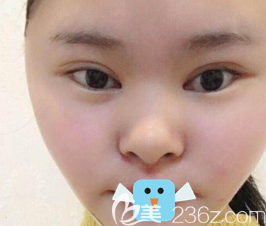 面部吸脂+眼綜合術(shù)后10天恢復(fù)照片 面部吸脂+眼綜合術(shù)后10天恢復(fù)照片