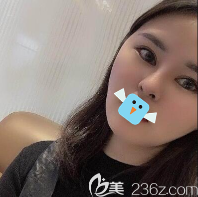 成都艾米麗程紅濤給我做了面部吸脂和眼綜合，我還是不滿足又做了假體鼻綜合，現(xiàn)在的我才是我想要的