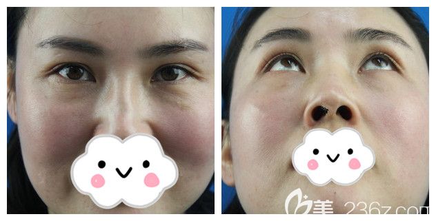 面診南京華韓奇致術(shù)前眼袋越來越<span style= 面診南京華韓奇致術(shù)前眼袋越來越<span style=