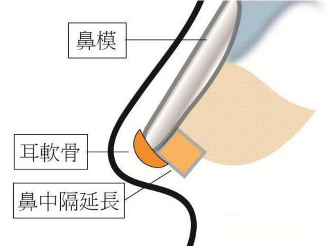韓國dvora整形醫(yī)院假體隆鼻失敗修復(fù)示意圖 韓國dvora整形醫(yī)院假體隆鼻失敗修復(fù)示意圖