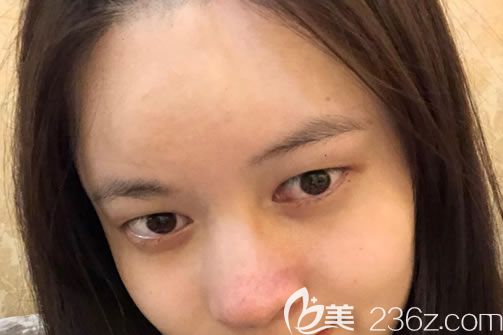 找溫州藝興做眼睛鼻子前 找溫州藝興做眼睛鼻子前