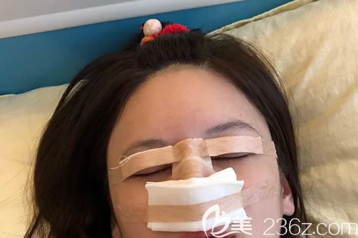 剛做完雙眼皮和隆鼻手術(shù)圖片 剛做完雙眼皮和隆鼻手術(shù)圖片