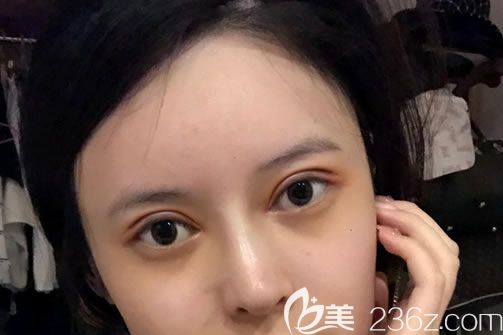 溫州藝星做雙眼皮和隆鼻7天后 溫州藝星做雙眼皮和隆鼻7天后