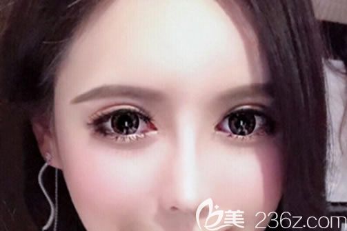 溫州藝興整形醫(yī)院做了雙眼皮和開(kāi)眼角+做鼻子,效果都挺不錯(cuò)的