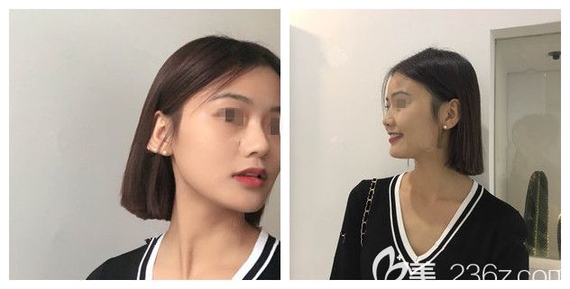 做完韓式生科硅膠墊下巴+假體隆鼻術(shù)后半個月恢復(fù) 做完韓式生科硅膠墊下巴+假體隆鼻術(shù)后半個月恢復(fù)