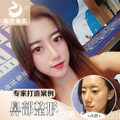 分享隆鼻+面部脂肪填充案例對比