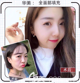 任傳琦醫(yī)生自體脂肪填充全面部的案例