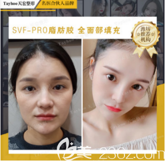 張明欣醫(yī)生自體脂肪填充案例