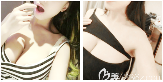 廣州美恩整形醫(yī)院許揚(yáng)濱做隆胸技術(shù)怎么樣 廣州美恩整形醫(yī)院許揚(yáng)濱做隆胸技術(shù)怎么樣