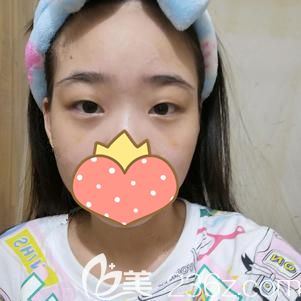 做玻尿酸豐淚溝術(shù)后6天眼袋變淺淚溝消失 做玻尿酸豐淚溝術(shù)后6天眼袋變淺淚溝消失