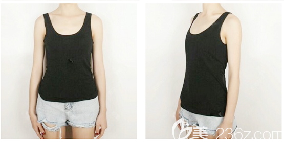 在廣州美恩整形醫(yī)院做隆胸術(shù)前照片 在廣州美恩整形醫(yī)院做隆胸術(shù)前照片