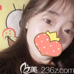 彭醫(yī)生做玻尿酸填充淚溝術(shù)后38天淚溝眼袋消失 彭醫(yī)生做玻尿酸填充淚溝術(shù)后38天淚溝眼袋消失