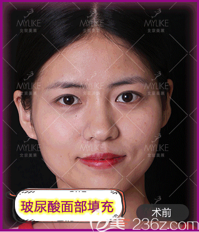 我在北京美萊做玻尿酸面部填充前樣子 我在北京美萊做玻尿酸面部填充前樣子