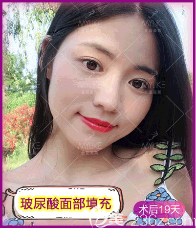 戴琴醫(yī)生給我做玻尿酸面部填充第19天效果 戴琴醫(yī)生給我做玻尿酸面部填充第19天效果