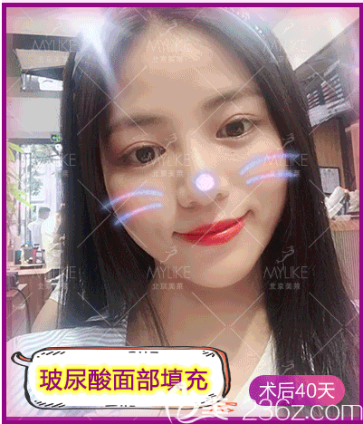 我在北京美萊做玻尿酸面部填充第40天效果 我在北京美萊做玻尿酸面部填充第40天效果