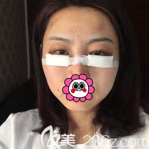 汪院長幫我做內(nèi)切去眼袋+面部填充術后即刻