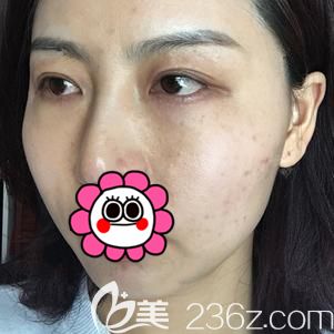 做內(nèi)切去眼袋+自體脂肪面部填充術后17天臉部腫脹未消