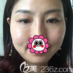 汪院長做內(nèi)切去眼袋+面部填充術后35天臉頰腫脹消除