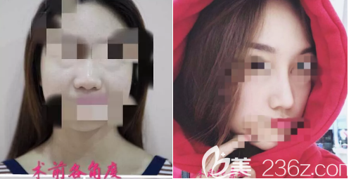 杜太超鼻綜合案例