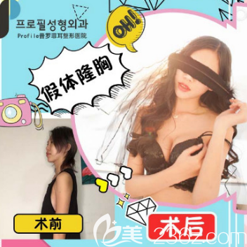 韓國profile醫(yī)院MOTIVA魔滴假體隆胸案例前后效果對比圖