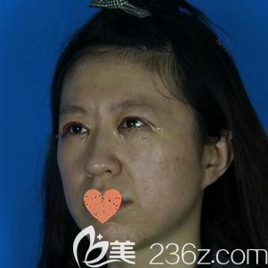 在鄭州華領(lǐng)剛做完雙眼皮和開眼角術(shù)后眼睛腫脹