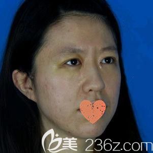 蘇鈺醫(yī)生為我做眼綜合術(shù)后7天進(jìn)行拆線