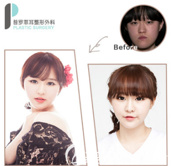 韓國普羅菲耳眼綜合整形案例
