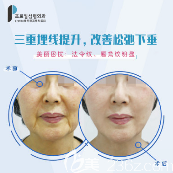 韓國普羅菲耳三重埋線提升案例