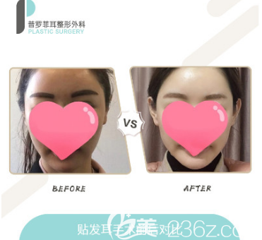 韓國貼發(fā)耳矯正案例前后效果對比圖