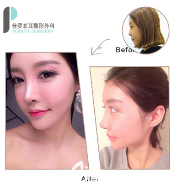 韓國普羅菲耳鼻綜合隆鼻案例