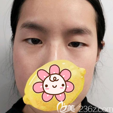 在深圳鵬程醫(yī)院做雙眼皮術(shù)前照片 在深圳鵬程醫(yī)院做雙眼皮術(shù)前照片