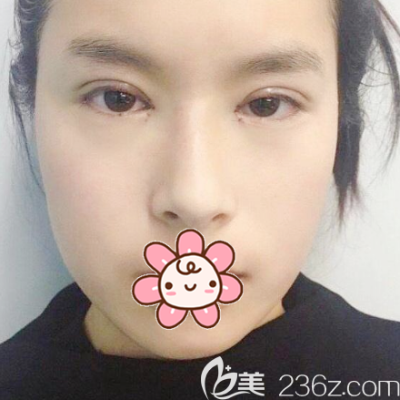 雙眼皮開眼角術(shù)后7天拆線 雙眼皮開眼角術(shù)后7天拆線