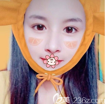 李子鵬醫(yī)生雙眼皮開眼角案例術(shù)后15天 李子鵬醫(yī)生雙眼皮開眼角案例術(shù)后15天