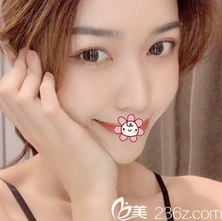 深圳鵬程醫(yī)院龐清澤做的脂肪填充案例兩個月效果很自然