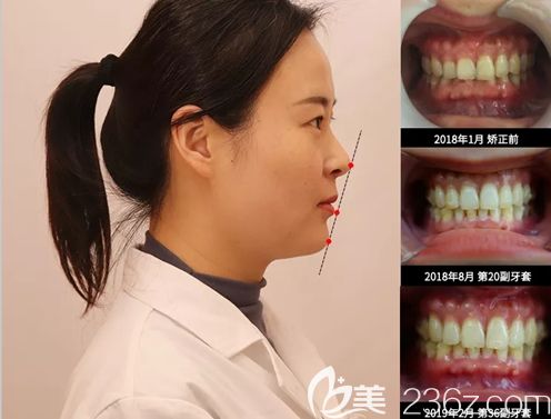 賈艷主任給自己做的隱形矯正效果圖 賈艷主任給自己做的隱形矯正效果圖