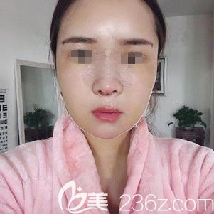 術(shù)后三天鼻綜合和面部脂肪填充恢復情況