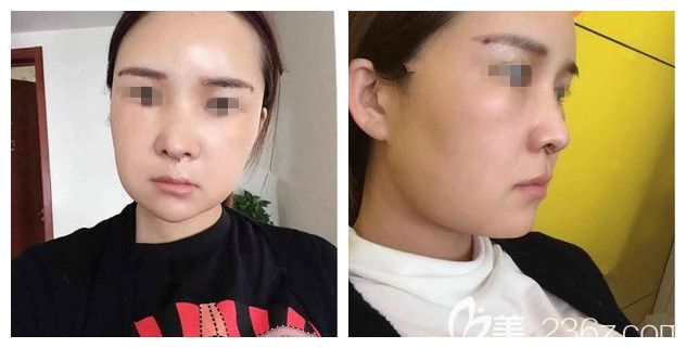 一周后鼻綜合+脂肪填充恢復效果