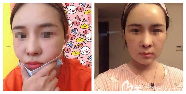 半個月后鼻綜合+面部脂肪填充恢復